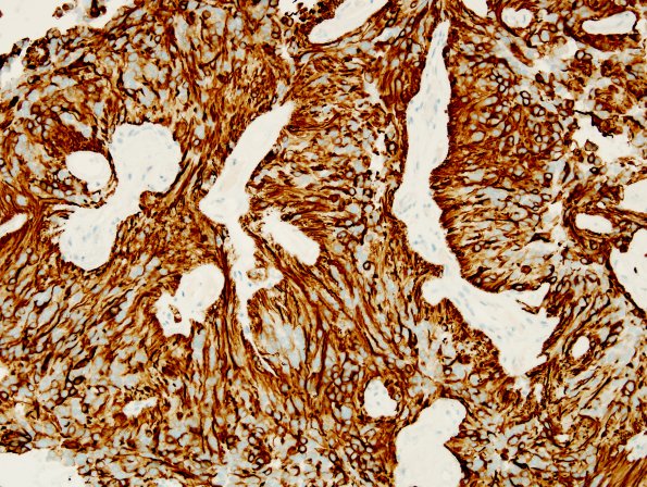 13B2 Ependymoma, myxopapillary (Case 13) GFAP 3