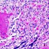 13C1 Ependymoma, myxopapillary (Case 13) PAS 1.jpg