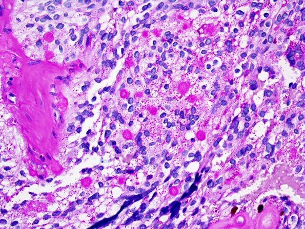 13C1 Ependymoma, myxopapillary (Case 13) PAS 1.jpg