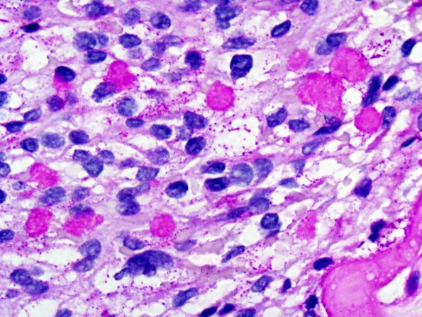 13C2 Ependymoma, myxopapillary (Case 13) PAS 2.jpg