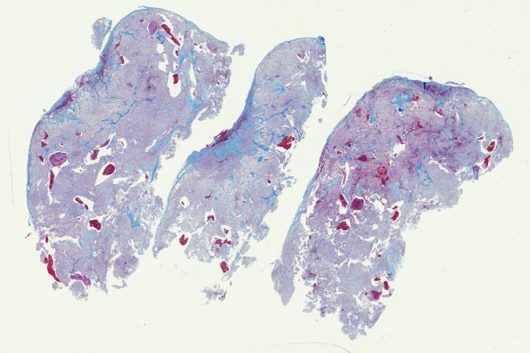 13D1 Ependymoma, myxopapillary (Case 13) Trichrome WM