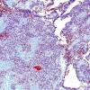 13D2 Ependymoma, myxopapillary (Case 13) Trichrome 6