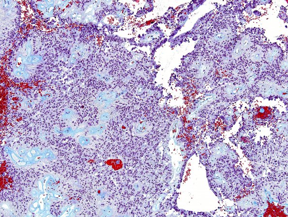 13D2 Ependymoma, myxopapillary (Case 13) Trichrome 6