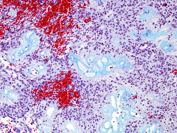 13D3 Ependymoma, myxopapillary (Case 13) Trichrome 2