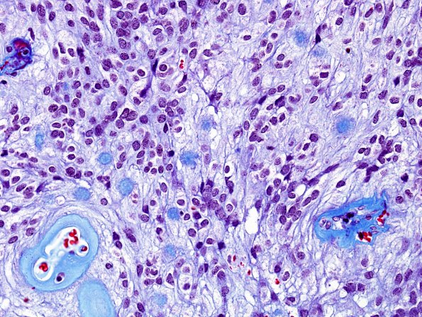 13D5 Ependymoma, myxopapillary (Case 13) (collagen balloons) Trichrome 13