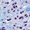 13D6 Ependymoma, myxopapillary (Case 13) Trichrome 9.jpg