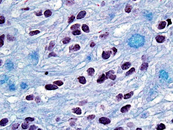 13D6 Ependymoma, myxopapillary (Case 13) Trichrome 9.jpg