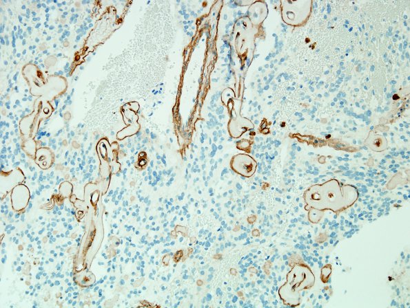 13E Ependymoma, myxopapillary (Case 13) Coll IV 4