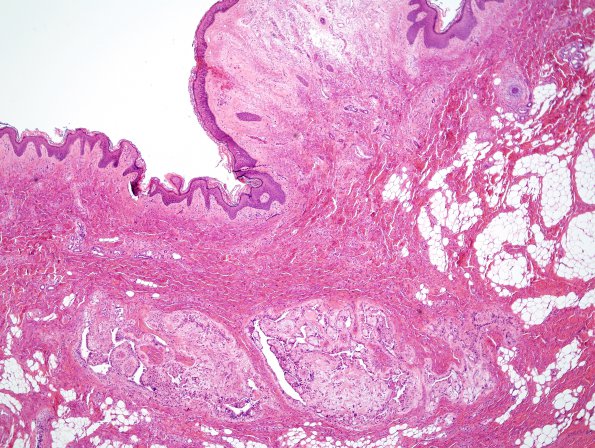 14A1 Ependymoma, myxopapillary, sinus tract (Case 14) H&E 12