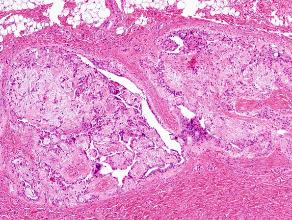 14A2 Ependymoma, myxopapillary, sinus tract (Case 14) H&E 17