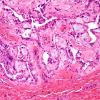 14A3 Ependymoma, myxopapillary, sinus tract (Case 14) H&E 6