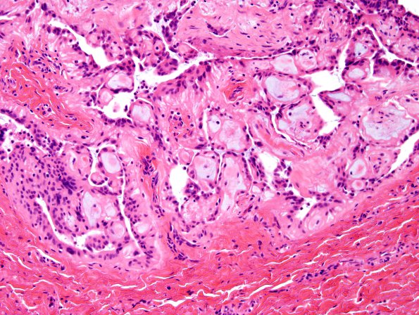 14A3 Ependymoma, myxopapillary, sinus tract (Case 14) H&E 6