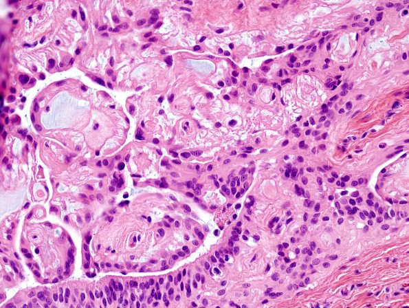 14A4 Ependymoma, myxopapillary, sinus tract (Case 14) H&E 9