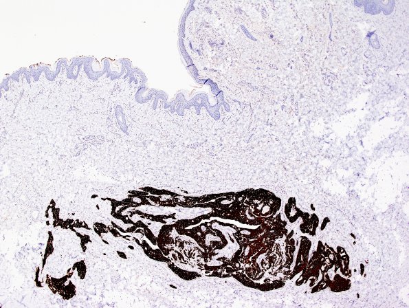 14B Ependymoma, myxopapillary, sinus tract (Case 14) GFAP 1