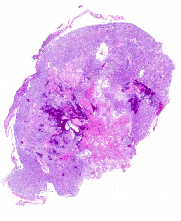 15A1 Ependymoma, myxopapillary (Case 15) H&E WM