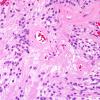 15A2 Ependymoma, myxopapillary (Case 15) H&E 3.jpg