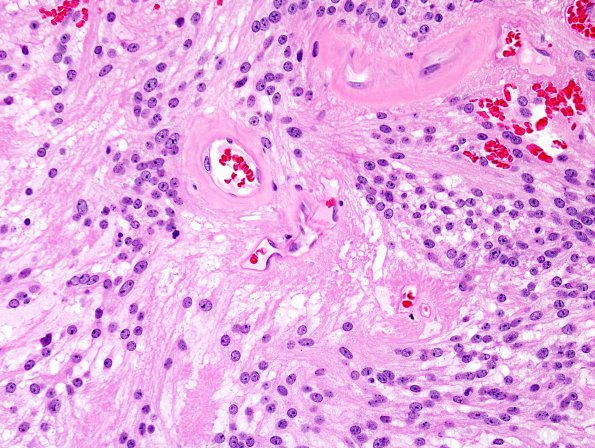 15A2 Ependymoma, myxopapillary (Case 15) H&E 3.jpg