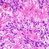 15A3 Ependymoma, myxopapillary (Case 15) H&E 6.jpg