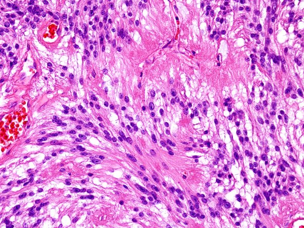 15A3 Ependymoma, myxopapillary (Case 15) H&E 6.jpg