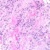 15A4 Ependymoma, myxopapillary (Case 15) H&E 8.jpg