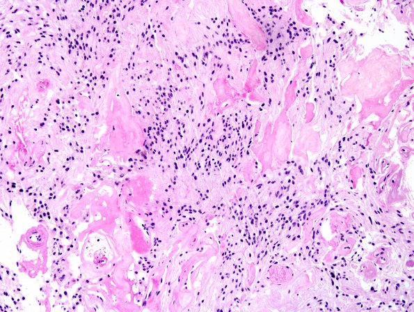 15A4 Ependymoma, myxopapillary (Case 15) H&E 8.jpg