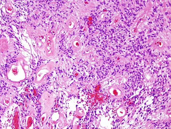 15A5 Ependymoma, myxopapillary (Case 15) H&E 4.jpg