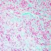 15B Ependymoma, myxopapillary (Case 15) Alcian Blue 2.jpg