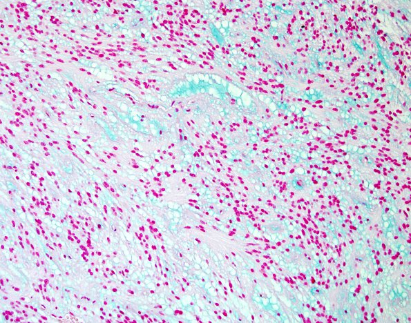 15B Ependymoma, myxopapillary (Case 15) Alcian Blue 2.jpg