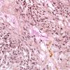 15C Ependymoma, myxopapillary (Case 15) Mucicarmine 2.jpg