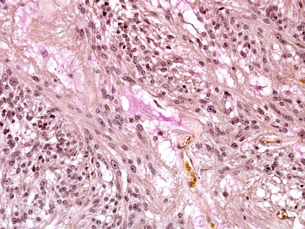 15C Ependymoma, myxopapillary (Case 15) Mucicarmine 2.jpg