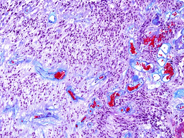 15D1 Ependymoma, myxopapillary (Case 15) Trichrome 3.jpg