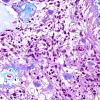 15D2 Ependymoma, myxopapillary (Case 15) Trichrome 1.jpg