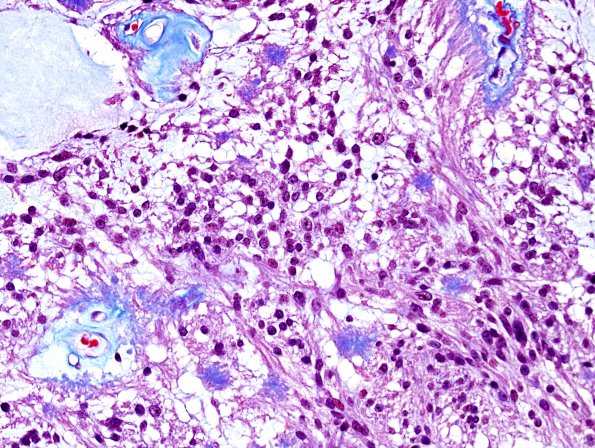 15D2 Ependymoma, myxopapillary (Case 15) Trichrome 1.jpg