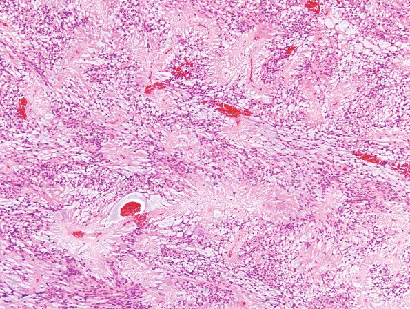 16B1 Ependymoma, myxopapillary (Case 16) H&E 3