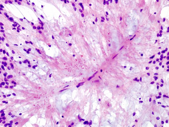 16B2 Ependymoma, myxopapillary (Case 16) (perivascular granules) 2