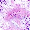 16B3 Ependymoma, myxopapillary (Case 16) (perivascular granules) 1