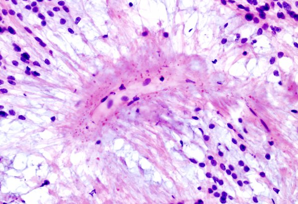 16B3 Ependymoma, myxopapillary (Case 16) (perivascular granules) 1