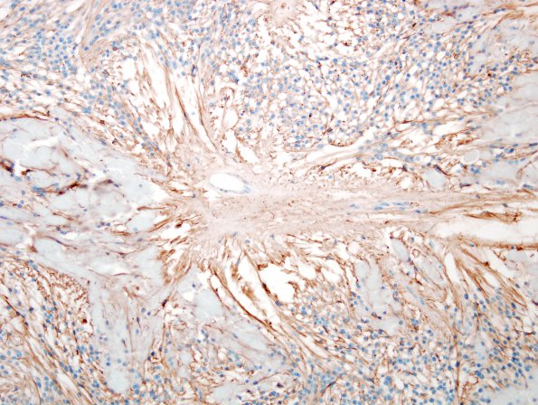 16C Ependymoma, myxopapillary (Case 16) GFAP (perivascular granules) 2