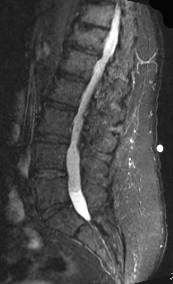 17A1 Ependymoma, myxopapillary (Case 17) STIR - Copy