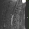 17A2 Ependymoma, myxopapillary (Case 17) T1 W (3) - Copy