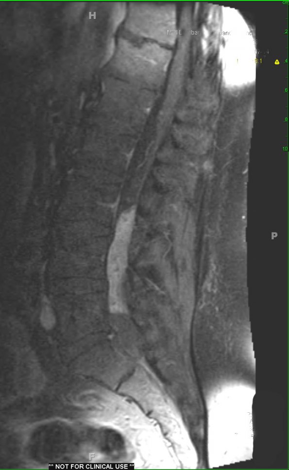 17A2 Ependymoma, myxopapillary (Case 17) T1 W (3) - Copy