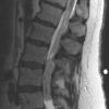 17A3 Ependymoma, myxopapillary (Case 17) T2 RESTORE 3 - Copy