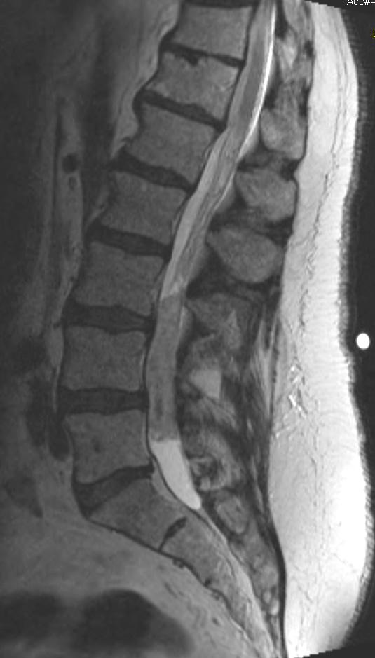 17A3 Ependymoma, myxopapillary (Case 17) T2 RESTORE 3 - Copy