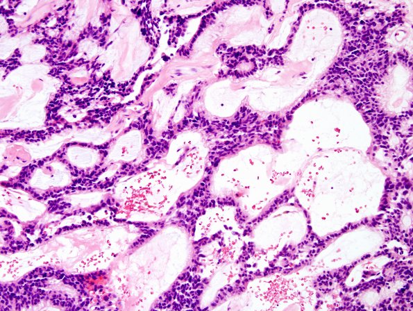 17B Ependymoma, myxopapillary (Case 17) H&E 2