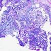 17C1 Ependymoma, myxopapillary (Case 17) Alcian Blue 1