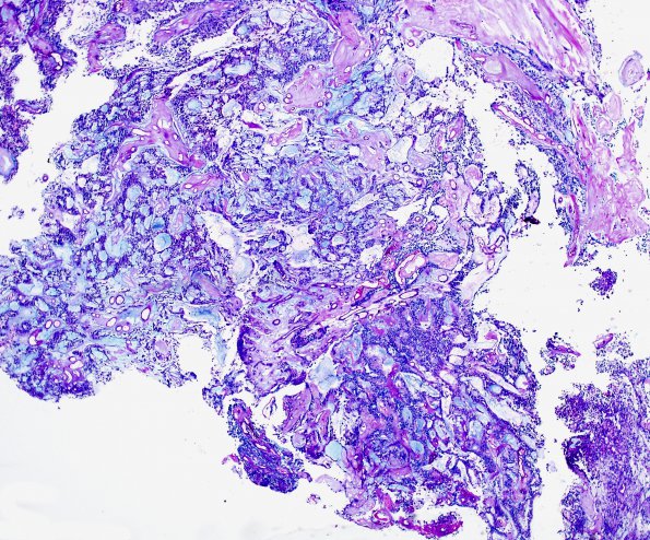 17C1 Ependymoma, myxopapillary (Case 17) Alcian Blue 1