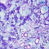 17C2 Ependymoma, myxopapillary (Case 17) Alcian Blue 2