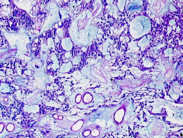 17C2 Ependymoma, myxopapillary (Case 17) Alcian Blue 2