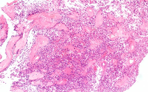 18A Ependymoma, myxopapillary (Case 18)_004 H&E 10X