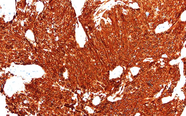 18B Ependymoma, myxopapillary (Case 18)_004 GFAP 20X